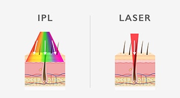 شباهت ها و تفاوت های بین لیزر و آی پی ال چیست ؟