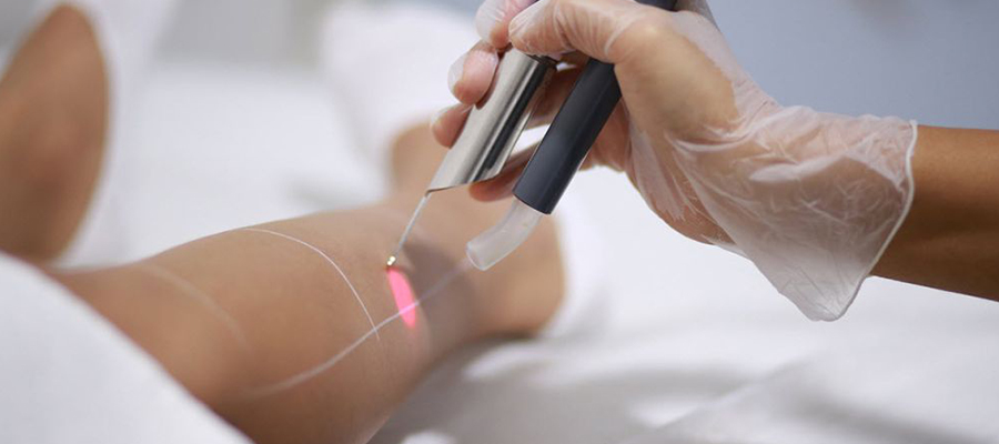 لیزر موهای زائد